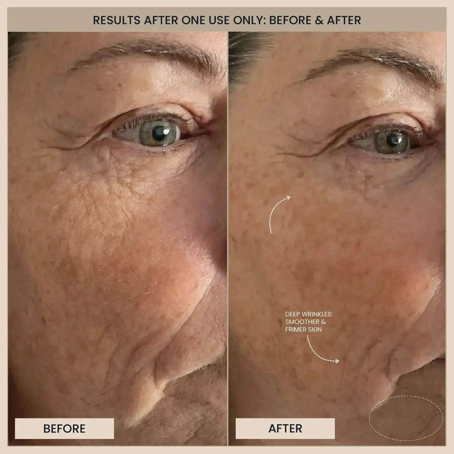 EvenSkyn® Lumo⁺: Premium Anti-Aging & Skin Tightening Handset (2026)